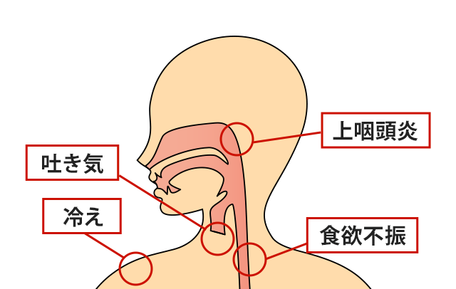 症状の該当箇所のイラスト